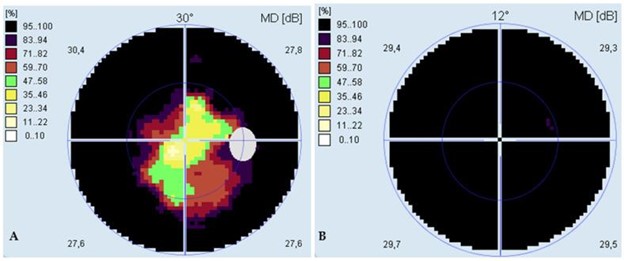 【佳学基因检测】巨额花费肾移植，却得了视网膜纤毛病：基因检测在肾病与眼科共病中的作用